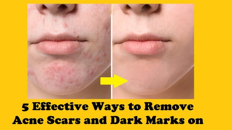 Effective Ways to Reduce Acne Scars and Dark Marks